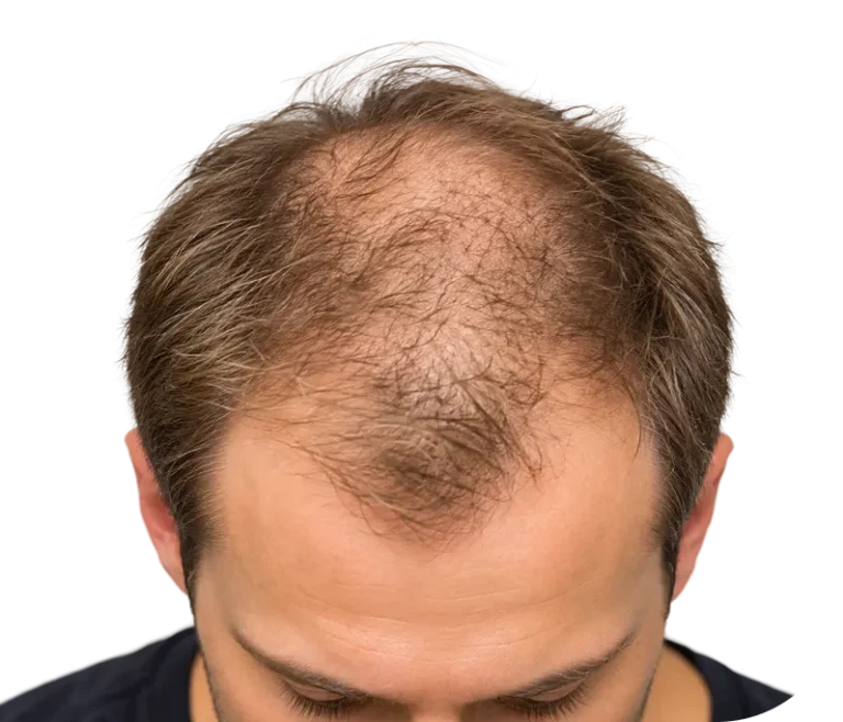 Hair Loss