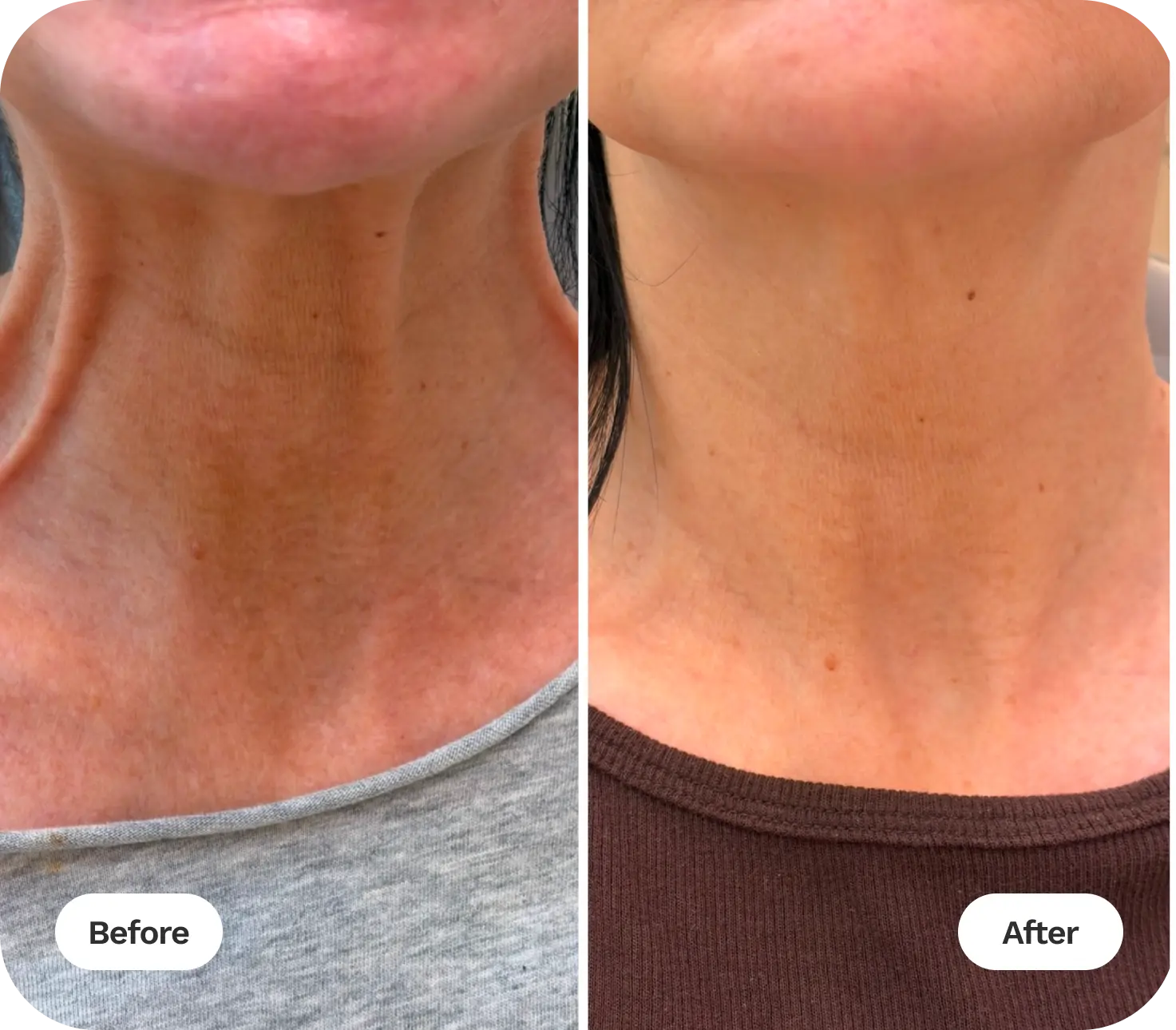 Neck Lift