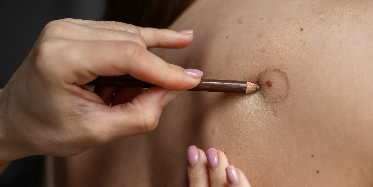 Mole / Skin Tag Removal