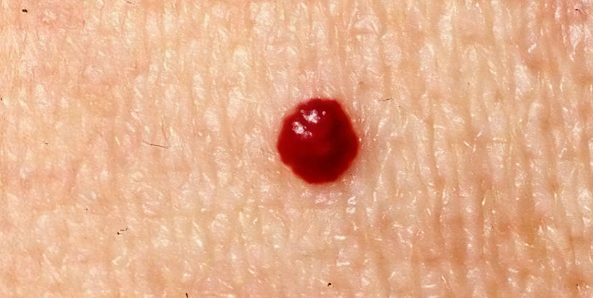 Cherry Angioma Closeup2