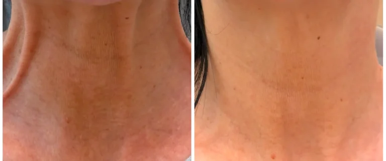 Secret RF Microneedling