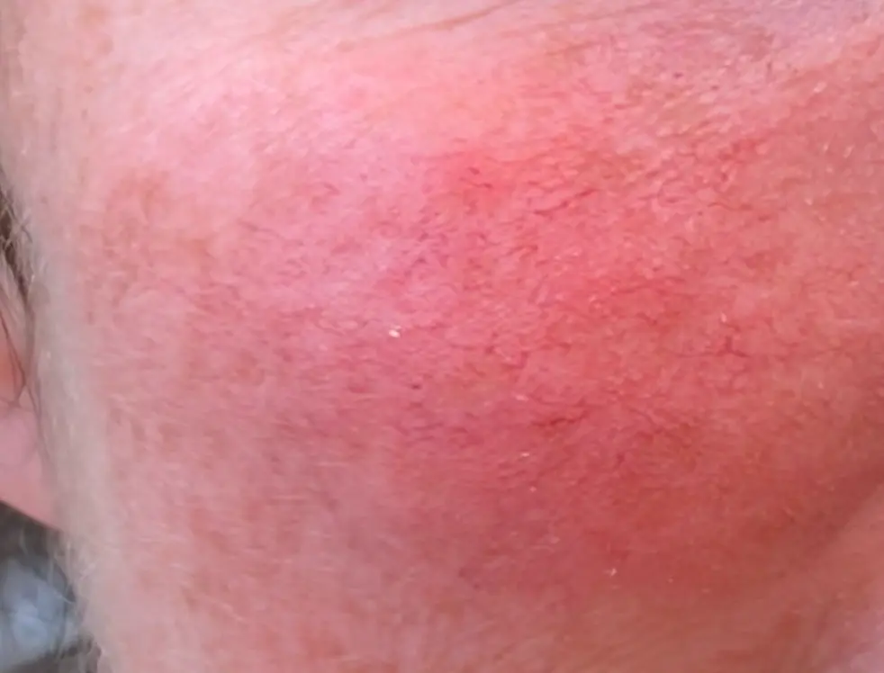 Rosacea Treatment