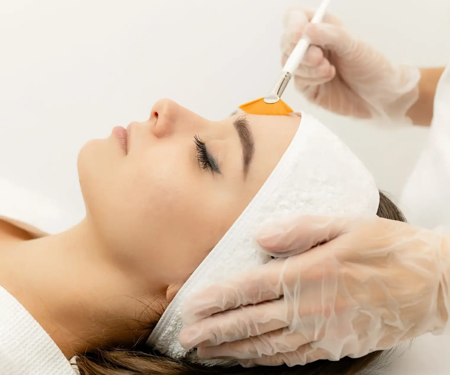 Chemical Peels