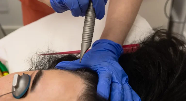 Fotona Hair Restoration