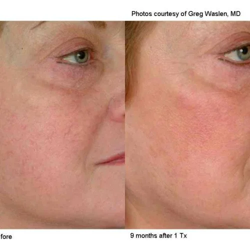 Laser Vascular Lesion Removal Ba
