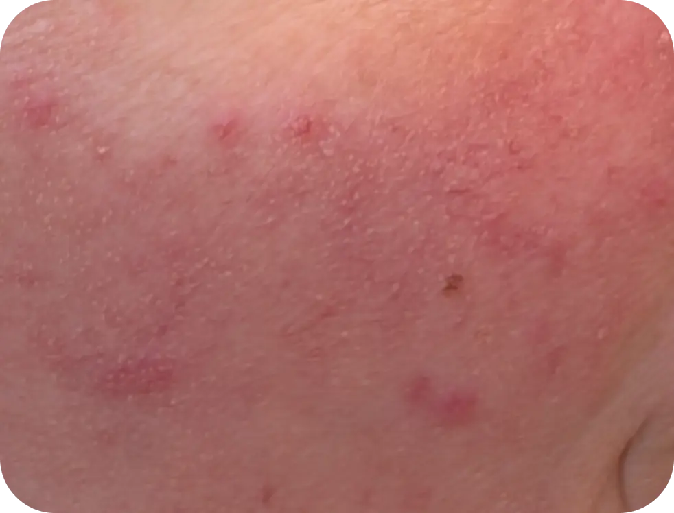 Portrait Young Woman Examines Her Face with Pimples