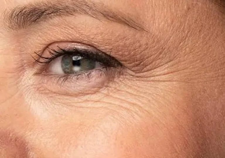 Wrinkle Reduction