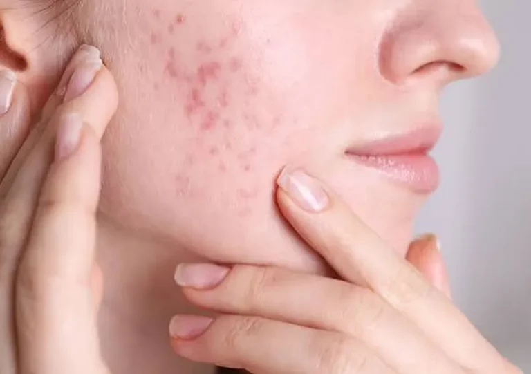 Acne Treatment